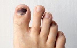Người gan kém thường gặp 3 vấn đề này ở bàn chân, mong rằng bạn không có dù chỉ là 1 điểm