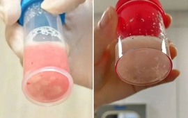 Cô bé 12 tuổi phổi trắng xóa và đông đặc sau 1 ngày bị sốt, bác sĩ cảnh báo: Đừng lúc nào cũng tưởng con cảm lạnh!