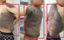 Bé trai Hà Nội mang khối u khổng lồ như "mai rùa" đến gặp bác sĩ: Sau 7 năm lần đầu tiên đứng thẳng như bao bạn bè trang lứa