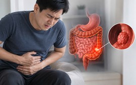 Bác sĩ bệnh viện Bạch Mai cảnh báo 4 DẤU HIỆU ung thư đường tiêu hóa: Nhiều người gặp nhưng chủ quan bỏ qua