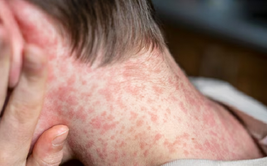 Bệnh sởi có thể gây biến chứng viêm não, mù lòa, viêm phổi: Thuộc 4 nhóm người này nên thận trọng