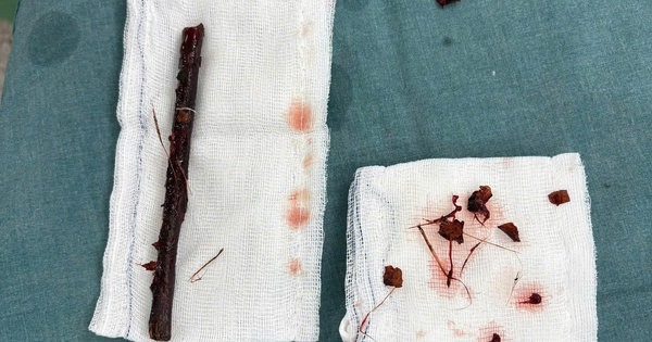 Hy hữu nhành cây dài 16 cm nằm trong bụng bé gái suốt 4 tháng