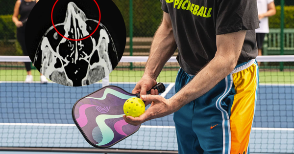 Người đàn ông TP.HCM gãy xương mũi vì chơi Pickleball
