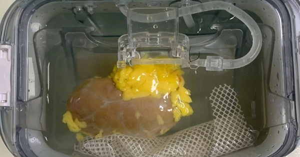 Tin vui cho người suy thận, cần ghép thận