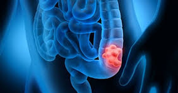 Cảnh báo: Yếu tố này khiến một người gần như chắc chắn mắc ung thư đại tràng nếu không được phát hiện