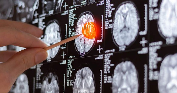 Sốc khi phát hiện 11 khối u trong não