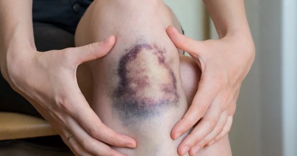 Người có 4 thứ này trên da dễ có "cả đống" tế bào ung thư trong người mà chưa biết