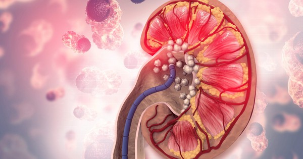 Người có axit uric máu cao thường có 3 đặc điểm này khi ăn uống: Có 1 cũng khiến thận sớm suy hỏng