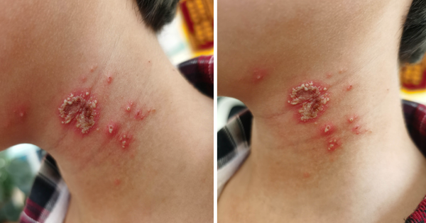 Bé trai 10 tuổi bỗng xuất hiện những nốt mẩn lạ trên da nhưng vẫn chưa tìm ra được nguyên nhân
