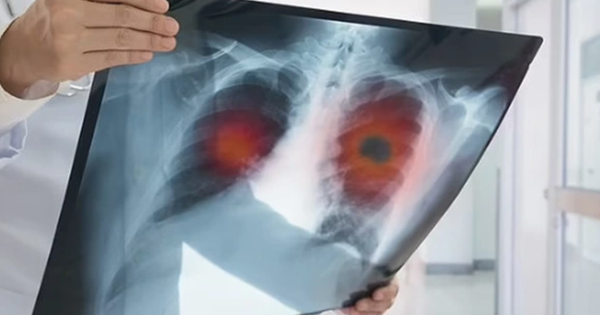 32 tuổi sống lành mạnh, sức khỏe tốt: Có 1 triệu chứng kéo dài 2 tuần, đi khám bỗng nhận kết quả K phổi