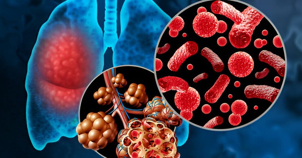 Nguy cơ bệnh phế cầu ở trẻ tăng cao: Chuyên gia cảnh báo cần dự phòng sớm