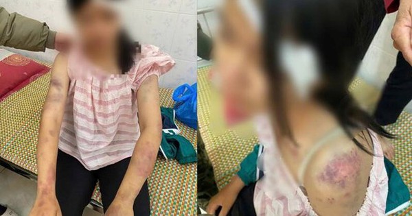 Bé gái 13 tuổi bị bà nội tra khảo, đánh đập dã man, người chi chít vết thương