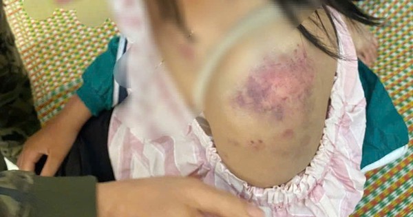 Bị bà nội và 2 người đàn ông bạo hành đến bầm tím khắp cơ thể, sức khỏe của bé gái hiện nay ra sao?