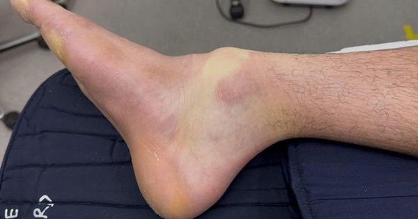 Đánh pickleball suốt 4 tiếng, nam thanh niên 28 tuổi gãy xương chân