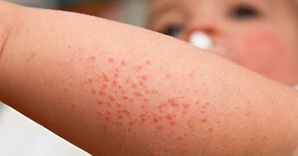 Dịch tăng 16,8%, sốt xuất huyết đe dọa mọi lứa tuổi, Việt Nam thành “điểm nóng”: Các chuyên gia cảnh báo dịch đã lưu hành quanh năm