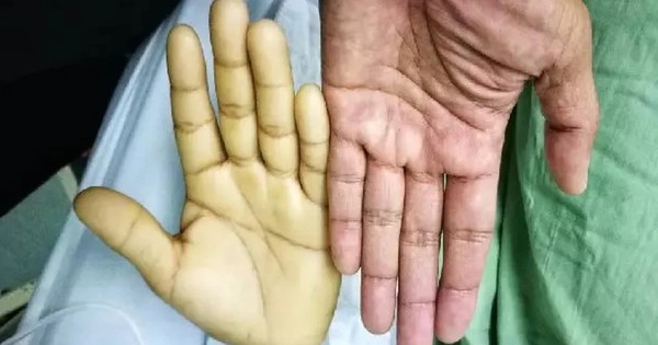 Vì sao ngày nào cũng uống sữa nhưng vẫn thiếu máu?