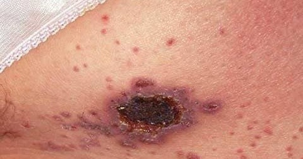 Đi khám da liễu, người đàn ông bàng hoàng nhận kết quả HIV: Những ca phát hiện khiến bác sĩ “giật mình”