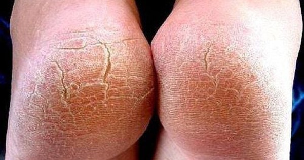 Đừng bỏ qua: 5 dấu hiệu ở bàn chân cảnh báo sức khỏe có vấn đề!