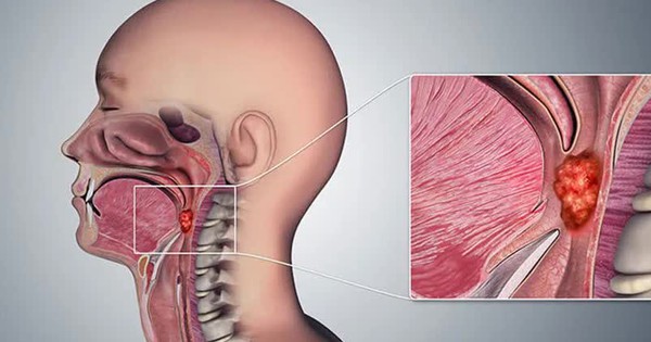 Phương pháp đột phá giúp điều trị hiệu quả ung thư vòm họng