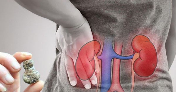 Người giữ 5 thói quen này có nguy cơ cao bị sỏi thận - căn bệnh đau "khủng khiếp" hơn cả sinh con