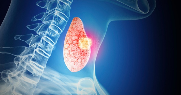 Bác sĩ CK II, khoa ung bướu nói thẳng: Nhiều người đang khoẻ, sau khi đi khám sức khoẻ định kỳ liền phát hiện ra ung thư - TẠI SAO?