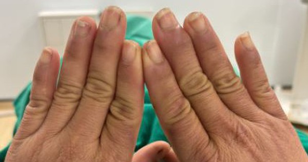 Người phụ nữ đau đớn mỗi khi chạm tay vào nước, đi khám ngỡ ngàng khi nhận kết quả