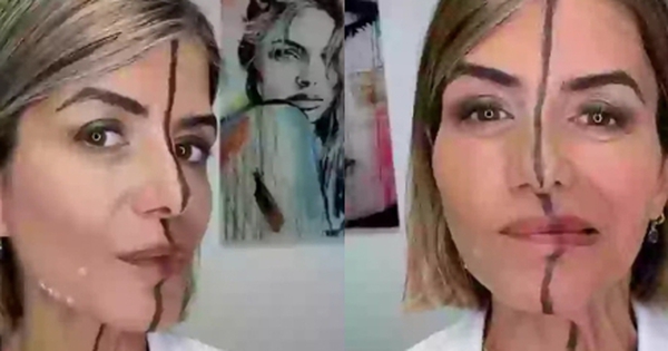 Nữ bác sĩ tiêm botox nửa khuôn mặt để chứng minh tác hại của cách làm đẹp này