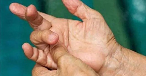 4 thay đổi ở ngón tay có thể là dấu hiệu ung thư phổi, hãy đi khám ngay!