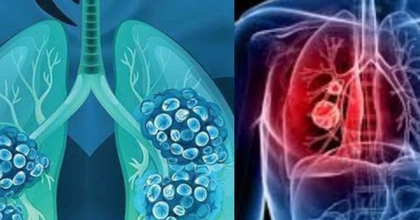 Cảnh báo không thể bỏ qua: Dấu hiệu sớm của UNG THƯ phổi không phải ho mà là 5 bất thường trên cơ thể