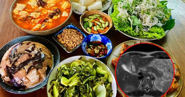 Người phụ nữ Hà Nội bất ngờ phát hiện tổn thương gan: Bác sĩ chỉ đích danh 2 thủ phạm