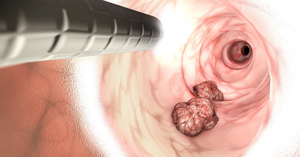 Ung thư giai đoạn sớm thường “rất ngoan”, bác sĩ Bạch Mai chỉ cách phát hiện và ngăn chặn kịp thời