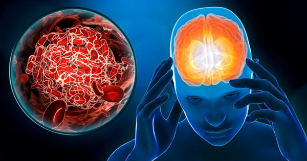 Đột quỵ, đau tim rất hay ‘nhắm vào’ đối tượng này: 7 điều cần làm ngay trước khi quá muộn