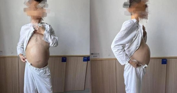 Người đàn ông 40 tuổi bụng to như mang bầu, khi phẫu thuật bác sĩ phát hiện điều đáng sợ
