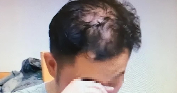 Nam sinh 16 tuổi đã hói nửa đầu vì 1 thói quen khi ngủ người càng trẻ tuổi càng dễ “sa vào bẫy”