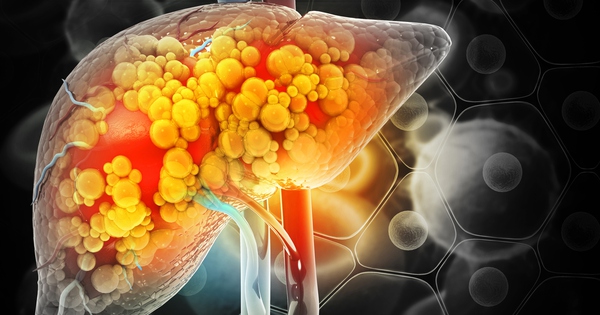 1 thói quen buổi tối tưởng vô hại nhưng đang khiến gan bị bào mòn mỗi ngày: Nếu có nên bỏ ngay!