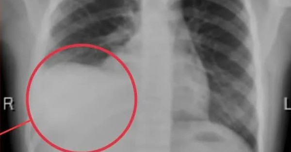 Cảnh báo tràn dịch màng phổi ở trẻ: Nguy hiểm nếu chậm phát hiện