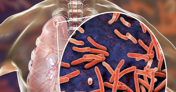 Bác sĩ chỉ ra 3 dấu hiệu sớm của bệnh Lao phổi: Nếu thấy phải đi khám ngay lập tức