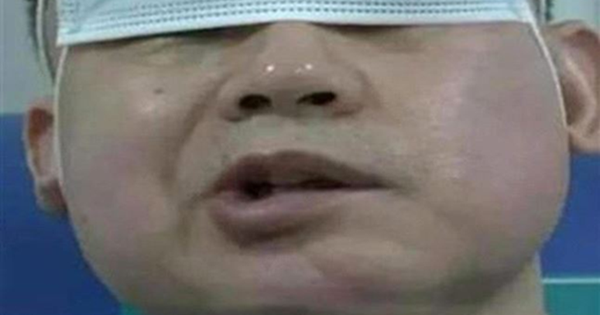 Bật điều hòa ngủ cho mát, người đàn ông bị liệt mặt, bác sĩ cảnh bảo thói quen yêu thích của người trẻ