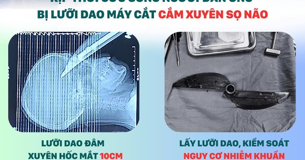 Hà Nội: Kịp thời cứu sống người đàn ông bị lưỡi dao máy cắt 50cm cắm vào đầu