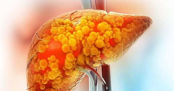 Khi gan "ngập" trong mỡ, cơ thể sẽ phát ra 5 tín hiệu vào ban đêm: Kiểm tra xem bạn có mấy?