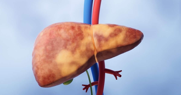 Cảnh báo 1 thói quen nhiều người mắc có thể khiến gan "ngập trong mỡ": Ai mắc cần sửa ngay!