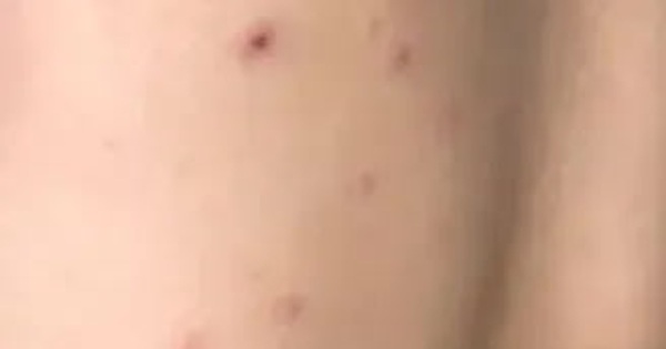 Cứu sống bé 10 tuổi bị thủy đậu biến chứng viêm não