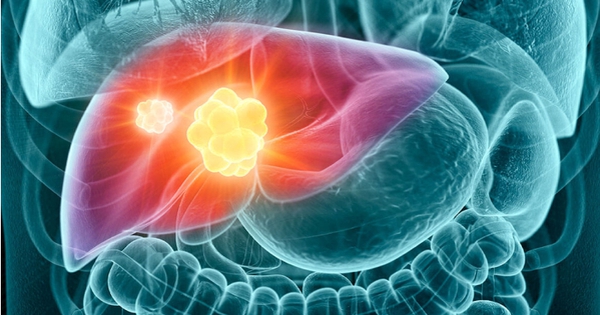 Phát hiện 2 "thủ phạm" khiến ung thư gan gia tăng chóng mặt: Làm ngay 3 điều này để giảm nguy cơ