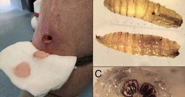 CDC phát hiện ca "giòi ăn thịt" đầu tiên trên người, cảnh báo lây lan ra cả gia súc, thiệt hại hàng tỷ USD