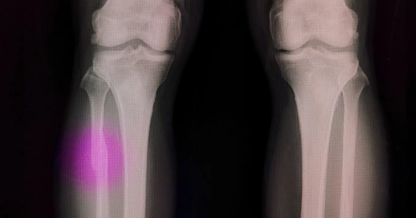 Kỷ nguyên mới của phẫu thuật chỉnh hình: Hàn Quốc phát triển "súng bắn keo 3D" tái tạo xương ngay trong quá trình phẫu thuật