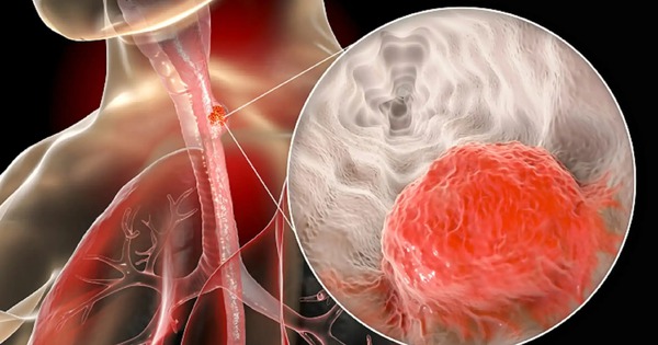 Nam giám đốc bất ngờ phát hiện ung thư giai đoạn 3: Hối hận vì đã bỏ qua 1 dấu hiệu suốt nhiều năm