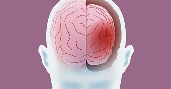 10 điều bộ não SỢ NHẤT: Có những hành vi dễ gây Alzheimer, teo não