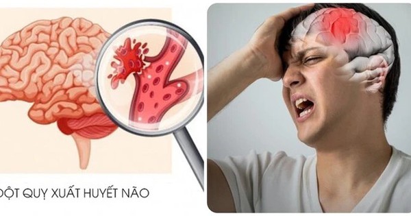 3 ngày trước khi bị nhồi máu não, 90% bệnh nhân đều làm 3 điều này: Số 2 ai cũng mắc!