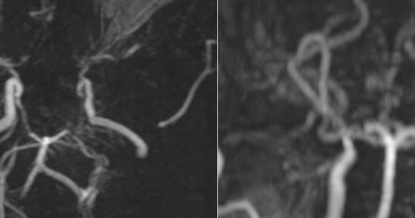 Hình ảnh MRI khiến bác sĩ bất ngờ: Mạch máu não bệnh nhân mờ như "khói thuốc"
