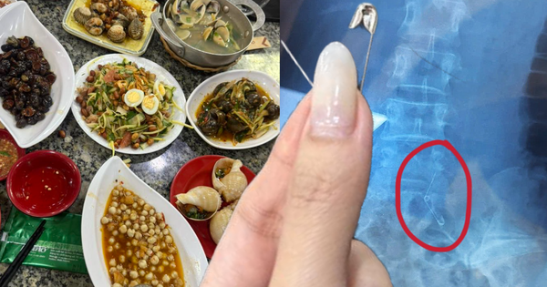 Đi ăn ốc, cô gái nuốt cả chiếc kim băng đang mở vào bụng, phải mổ cấp cứu 6 tiếng, tốn 70 triệu